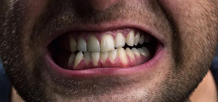Close de boca de homem com os dentes cerrados