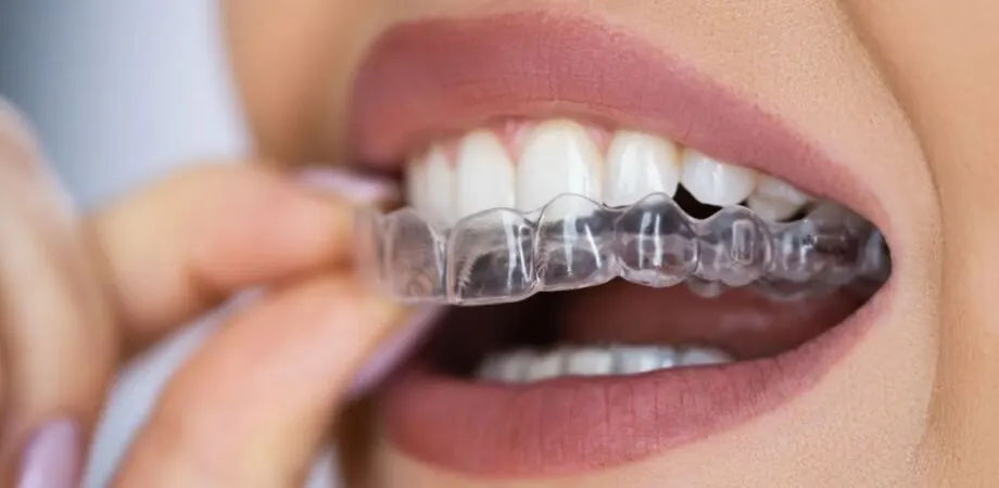 Placa transparente sendo encaixada nos dentes superiores