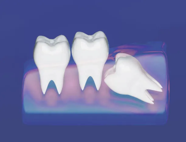Ilustração de molares com o dente siso nascendo inclinado contra o dente vizinho