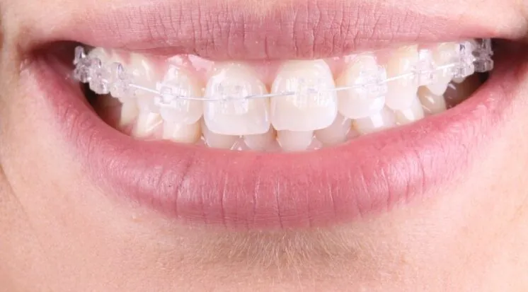 Sorriso com aparelho fixo de bráquetes transparentes
