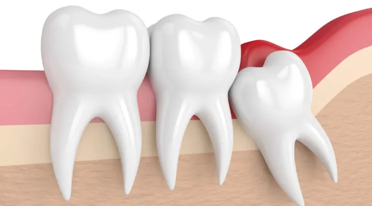 Ilustração de molares com o dente siso nascendo inclinado contra o dente vizinho e a gengiva avermelhada