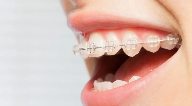 Sorriso com aparelho fixo de bráquetes transparentes