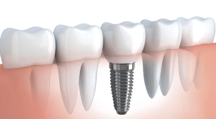 Ilustração de implante dentário com coroa entre dentes naturais