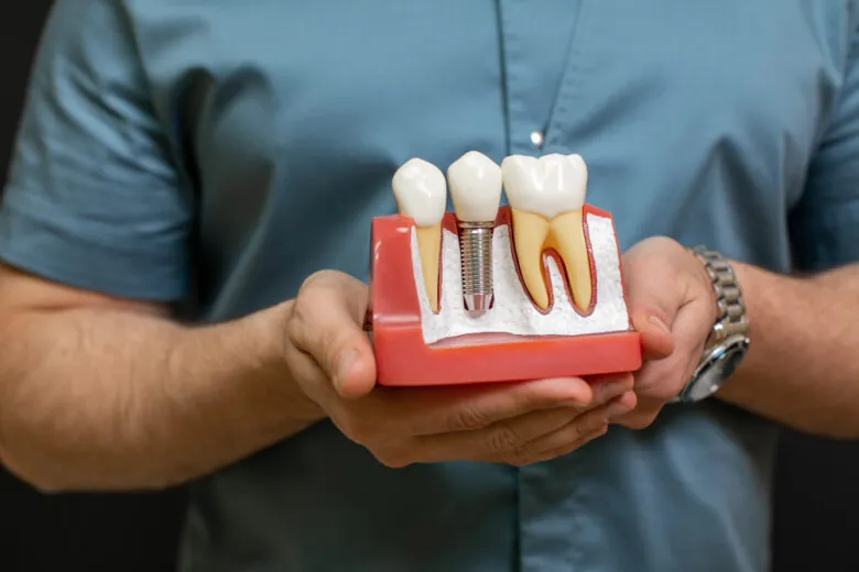 Dentista segurando modelo de arcada com implante dentário