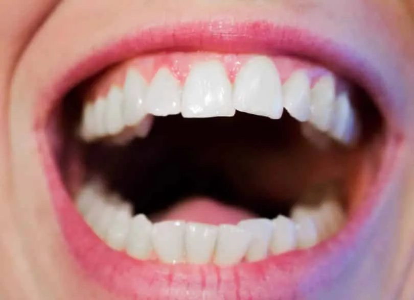 Boca aberta mostrando dentes levemente desalinhados, sem aparelho