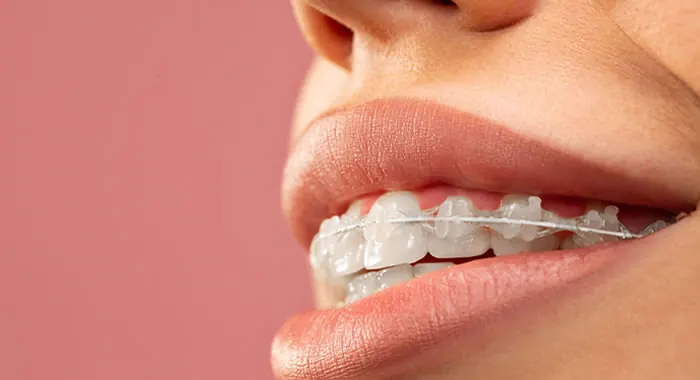 Close de dentes com bráquetes transparentes e fio ortodôntico
