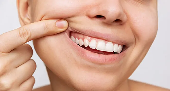 Pessoa levantando o lábio superior com o dedo e mostrando a gengiva acima dos dentes