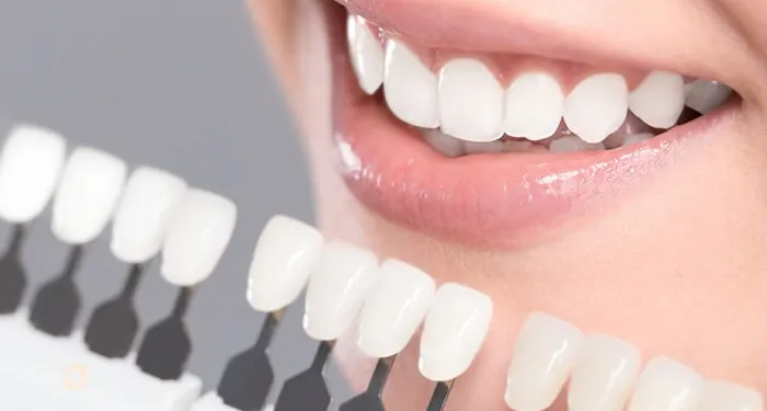 Escala de cores de dentes em primeiro plano diante de um sorriso