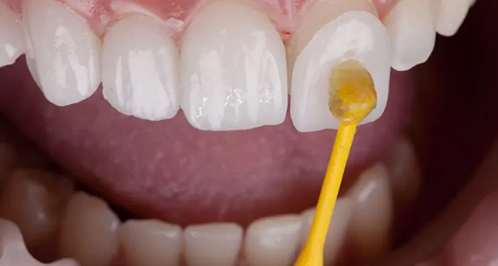 Lâmina de porcelana sendo posicionada no dente da frente com um aplicador