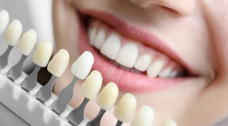 faceta-ou-lente-de-contato-dental-746x413